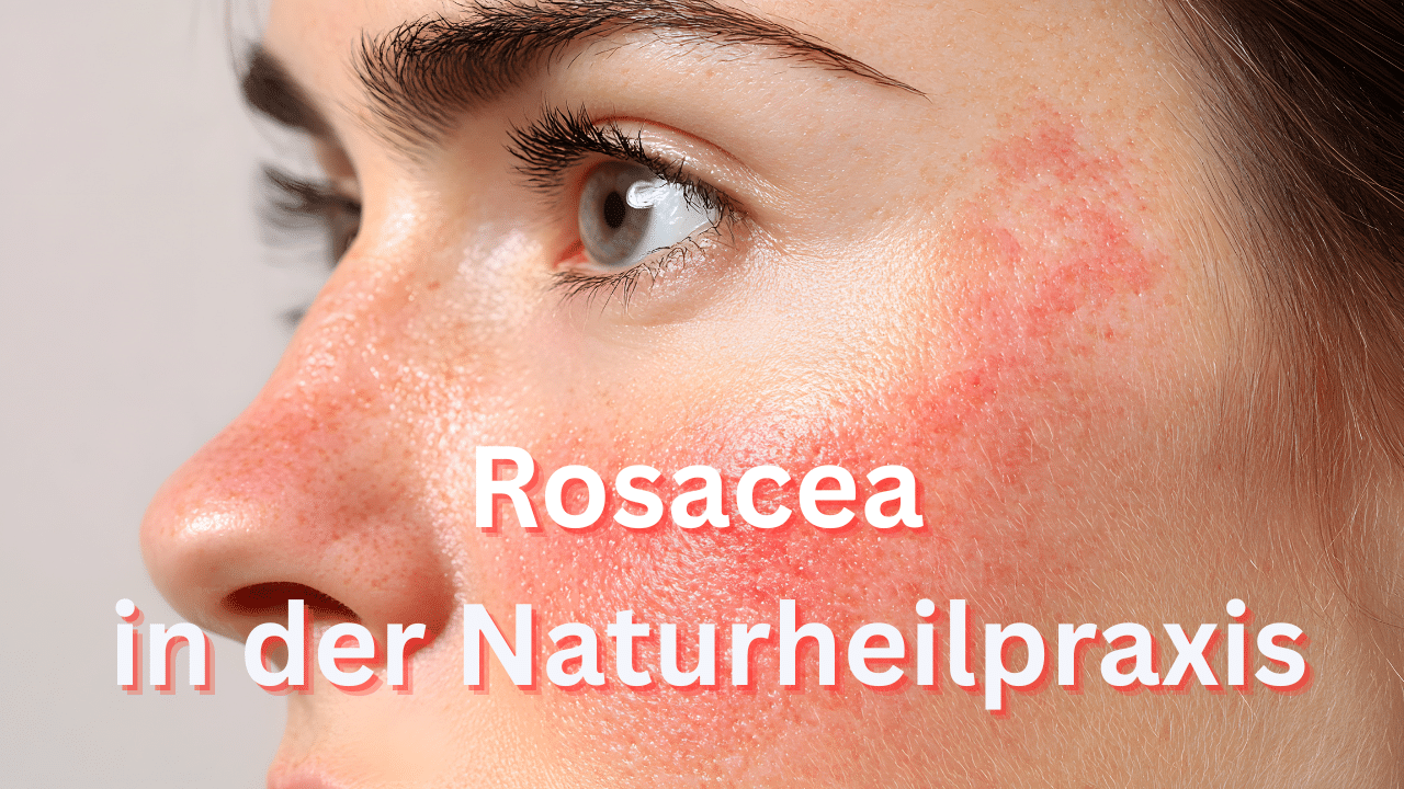 Mehr über den Artikel erfahren Rosacea: Behandlung in der Naturheilpraxis